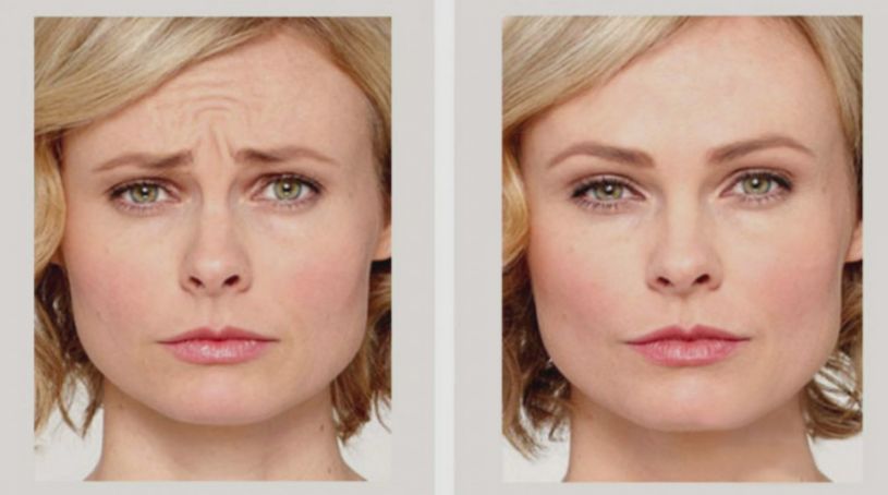 Before & After